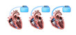 heart and cardiac pacemaker on white background 3d render, heart anatomy, section, right and left ventricle, atria, valves
