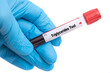 Triglycerides Test Medical check up test tube with biological sample