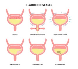 urination older nerve brain spasm urge pass urine of pelvic floor muscle frequently Bed wetting toilet tract tumor cancer stroke stress atonic Benign Lower Often leak anuria Neural Cystitis cord