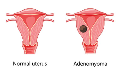 Wall Mural - Adenomyoma Adenomyosis Human anatomy Female reproductive Sick and normal system organs. Location scheme uterus icon. Vector medical Cross section disease illustration isolated on white background