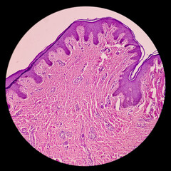 Sticker - Infected wound tissue: Foreign body granuloma, skin, subepithelial tissue show granuloma, dense infiltration of polymorphs, lymphocyte, histiocytes and plasma cells.