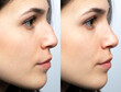 © Alessandro Grandini - Nose before and after nasal filler surgery