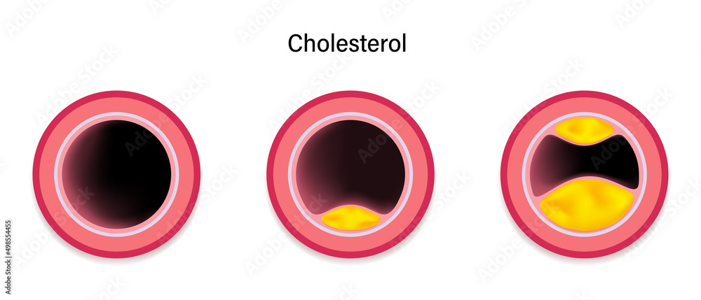 Cholesterol accumulation in blood vessels. Atherosclerosis. Clogged ...
