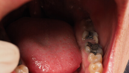 Decayed tooth root canal treatment. Tooth or teeth decay of lower molar. Restoration with a composite filling. Adult caries. bad teeth. Dental temporary restorative material. Dental concept. close up.