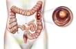 Digestive system: the colon with a colonic polyp.