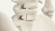 Vertebral Fracture Due To Osteoporosis Of The Spine - 3d Rendering