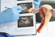 Female Doctor Pointing At Ultrasound Analysis Of Ovary, Transvaginal Ultrasound Of Uterus