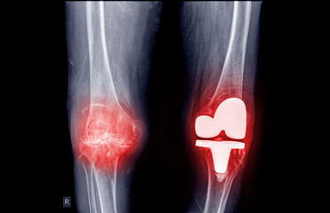 Wall Mural - film x-ray both knee AP view of osteoarthritis knee patient and artificial joint with knee replacement.