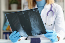 Doctor Traumatologist Examines X-ray Of Feet Closeup