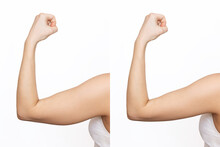 Two Shots Of A Young Woman With Excess Fat On Her Arm And Toned Arm Before And After Losing Weight Isolated On A White Background. Result Of Diet, Liposuction, Training. Plastic Surgery Concept