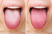 Female Tongue With A White Plaque. Comparison Of A Diseased Tongue With A White Plaque And A Healthy Clean Tongue Before And After Treatment. The Result Of Cleaning The Tongue