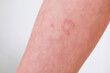 The child has allergic contact dermatitis on the skin.