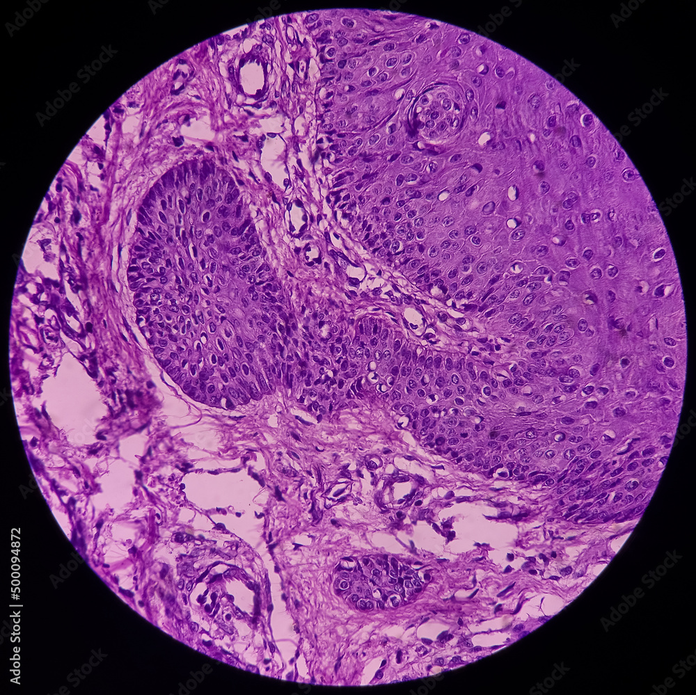 Micrograph of verrucae or chin skin wart, microscopic show epidermal ...