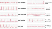 Schemes Set Of Common Electrocardiogram (ECG) Abnormalities, Including Partial Blocks And Flutter