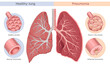Pneumonia symptoms medical diagram. Healthy lung and lung with pneumonia.