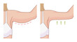 Woman hands fat loss illustration before and after exercises. 