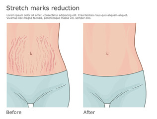 Woman belly with and without stretch marks. Before correction and after.  