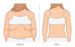 Back weight loss illustration. Woman's back before and after weight loss. 