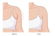 Reduce armpit fat illustration. Woman armpit fat loss vector illustration. Before and after.