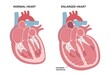 Enlarged athlete's heart angina x-ray edema test diagnose chest pain high blood pressure sudden death shock stress test