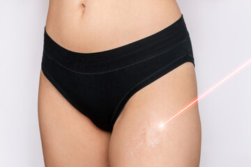 Wall Mural - Laser scar removal. Cropped shot of a young woman with a burn scar on her thigh with a red laser beam aimed at this isolated on a gray background. Skin problem. Cosmetology, beauty