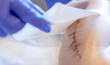 The doctor applies a patch to the scar after surgery on the child's leg. Antibacterial patch.