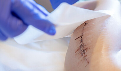 the doctor applies a patch to the scar after surgery on the child's leg. antibacterial patch.