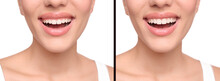 Young Woman Before And After Gingivoplasty Procedure On White Background, Closeup. Banner Design