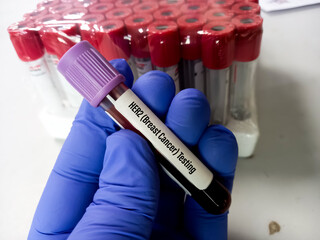 Sticker - Blood sample for Her-2 breast cancer testing, human epidermal growth factor receptor 2(HER2), ERBB2 Amplification.