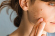 Woman with red cheeks- diathesis or allergy symptoms. Redness and peeling of the skin on the face. Teenage girl with acne problem on beige background, closeup.