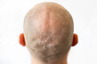 © _KUBE_ - Male bald flaky head with dandruff close-up, back view. White background. The concept of psoriasis and skin problems