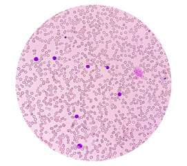 Poster - Acute lymphoblastic leukemia or Acute leukemia under microscopic examination in medical laboratory