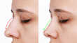 A profile of woman's face with nose before and after rhinoplasty isolated on a white background. Comparison after cosmetic plastic surgery on the hump of the female nose. Beauty concept