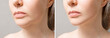 Leinwandbild Motiv Female double chin before and after correction. Correction of the chin shape liposuction of the neck. The result of the procedure in the clinic of aesthetic medicine.