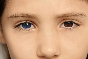 Little girl with different colors of eyes, closeup. Heterochromia iridis