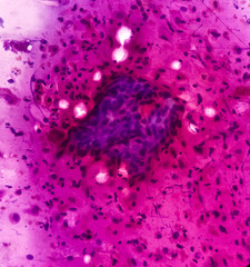 Poster - Squamous intraepithelial lesion(SIL). Pap's smear. Reactive cellular changes associated with severe inflammation. Focus view.