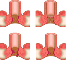 肛門　痔　病気　イラスト