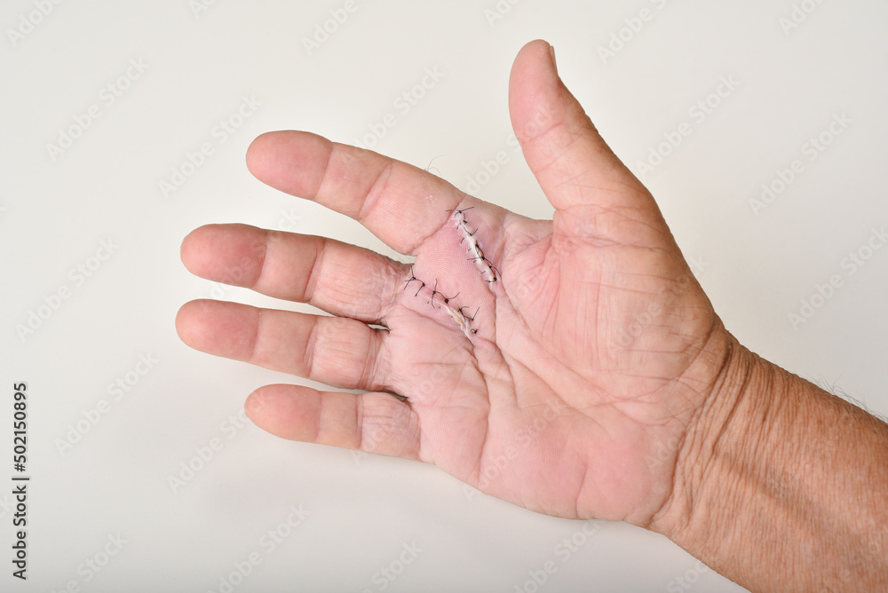 Photo Stock Hand surgery treatment, Trigger finger stiffness painful ...