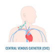 Central venous catheter placed in the jugular vein. Man with CVC access device. Internal jugular venous IJV cannulation procedure. Medical vector illustration.