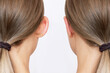 © Марина Демешко - Cropped shot of woman's head with ears before and after otoplasty isolated on a white background. Result of cosmetic plastic surgery of correction auricles and getting rid of lop - eared