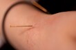 © Joeri - A portrait of a thin acupuncture needle placed below the wrist, put in place by an acupuncturist. This alternative medicine treatment is used for healing, relaxing, stimulation and stress relief.