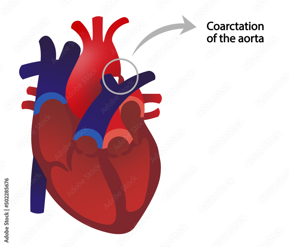 Coarctation of the aorta illustration. Stock Illustration | Adobe Stock