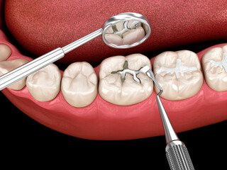 Decayed tooth restoration with composite filling. Dental 3D illustration