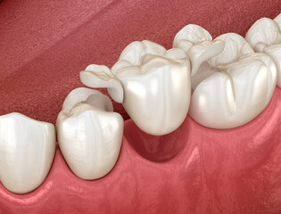 Wall Mural - Maryland bridge made from ceramic, premolar tooth recovery. Dental 3D illustration