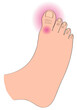 © SuperStock - Close-up of foot with gout
