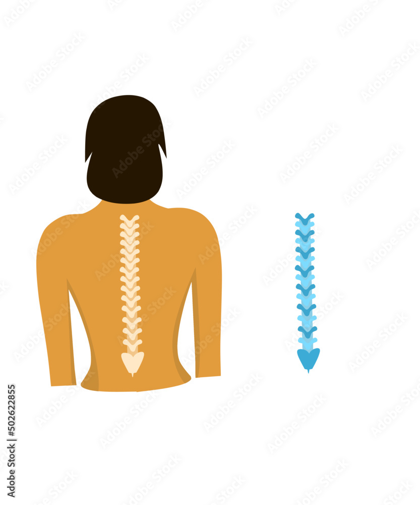 Vector de Stock Woman scoliosis flat vector illustration. Types of ...