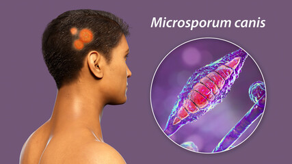 Wall Mural - Fungal infection on a man's head, 3D illustration