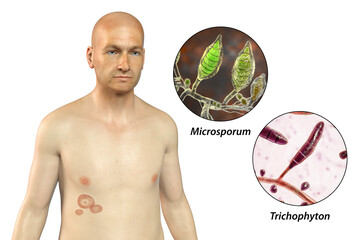 Sticker - Fungal infection on a man's body. Tinea corporis, 3D illustration