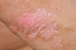 Manifestation of psoriasis on the skin of the elbow