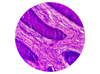 Wall Mural - Skin Cancer: Skin biopsy under microscope showing Basal cell carcinoma.